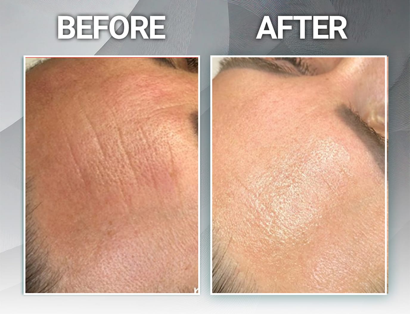 Fine-line and surface renewal before and after Peeling for Skin Regeneration