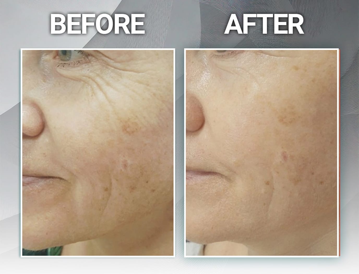 Softening around the eye contour before and after Peeling for Skin Regeneration