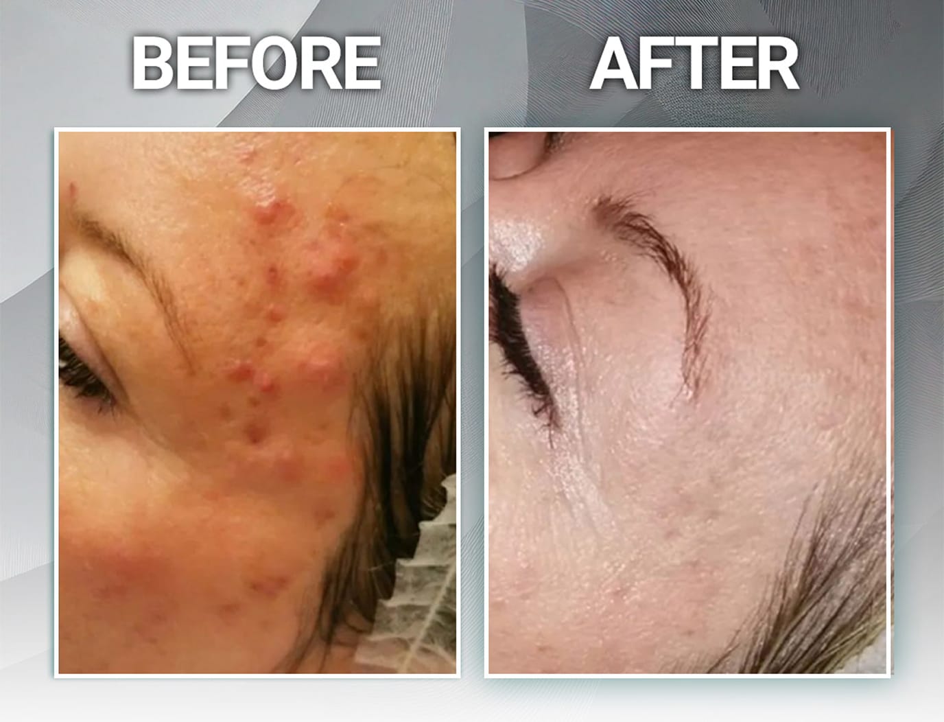 Congestion and blemish recovery before and after Peeling for Skin Regeneration