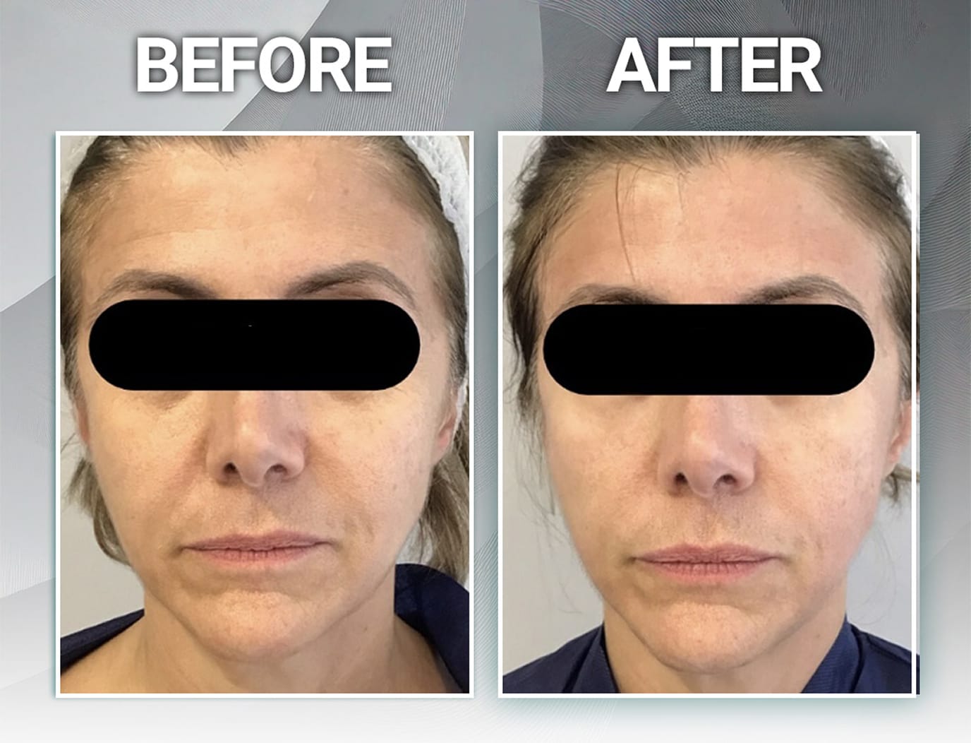Full-face tone and texture refinement before and after Peeling for Skin Regeneration